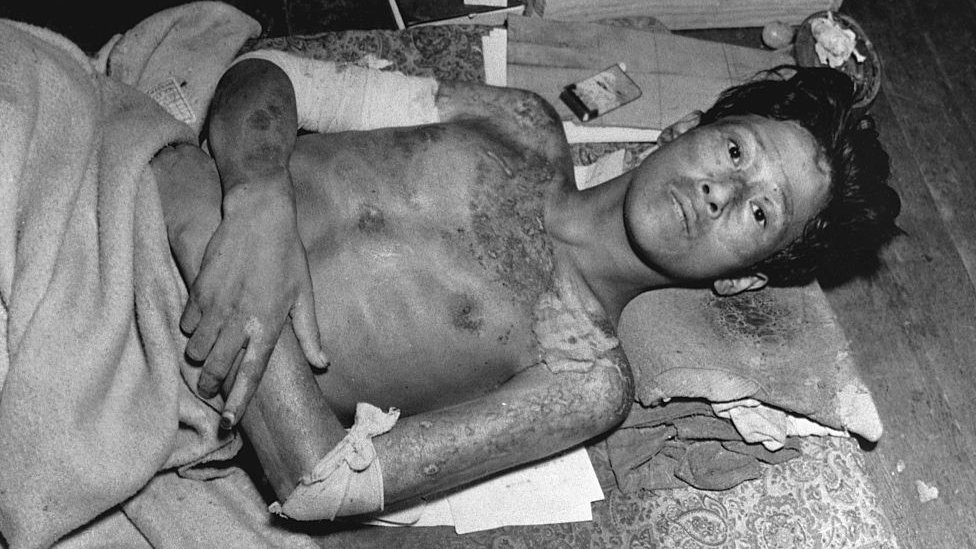 ১৯৪৫ সালে নাগাসাকির হামলা থেকে বেঁচে যাওয়া একজন ১৯৪৫ সালে নাগাসাকির হামলা থেকে বেঁচে যাওয়া একজন