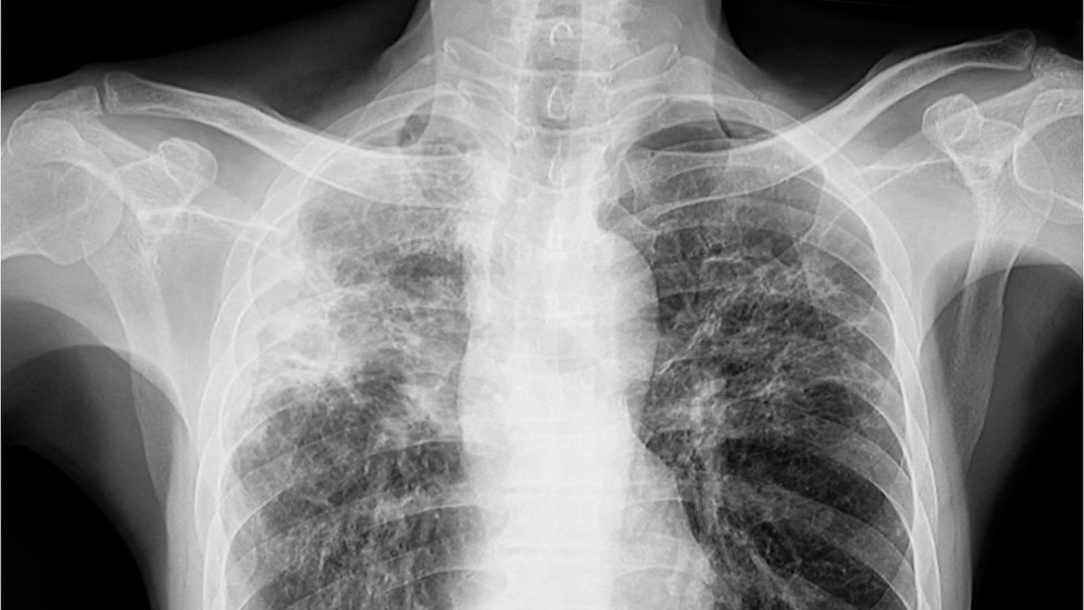 যক্ষ্মা