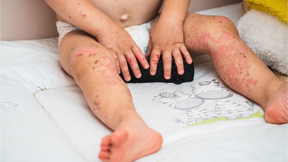 টমেটো ফ্লু